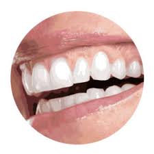 We did not find results for: Adult Overbite What It Is And How To Correct It Smile Prep