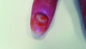 nail psoriasis with lesions in the nail