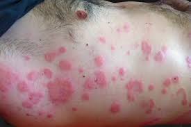 are hives a symptom of hiv