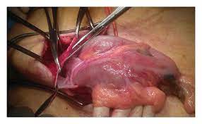 opening of the inguinal hernia sac