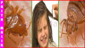 how to get rid of head lice fast