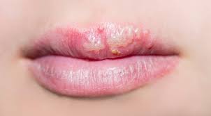 cold sores pics types causes