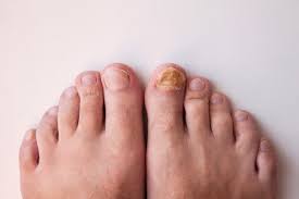 toenail fungus edmonton foot health