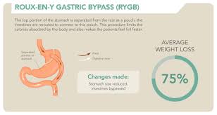 island hospital bariatric surgery