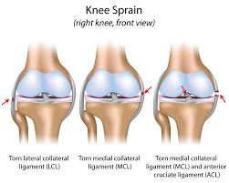 The acl, or anterior cruciate ligament, keeps the knee from sliding forward.the pcl, or posterior cruciate ligament, keeps the knee from sliding backward.an acl or pcl injury occurs when the ligament has been torn.an acl injury may happen at the same time as a cartilage injury of the knee. Injured Your Acl Take Care Of Your Other Knee Ligaments Too