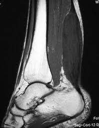 Clinical features and differential diagnosis with mr imaging. Disorders Of The Ankle And Foot Posterior Radiology Key
