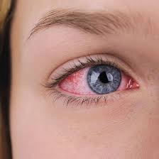Eye twitching (or myokymia) is an involuntary eyelid muscle contraction, which typically affects your lower eyelid, not your actual eyeball. Eye Health What Your Eye Symptoms May Mean