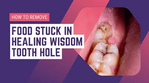 healing wisdom tooth hole with