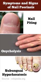 Maybe you would like to learn more about one of these? Nail Psoriasis Causes Symptoms Diagnosis Treatment Prevention