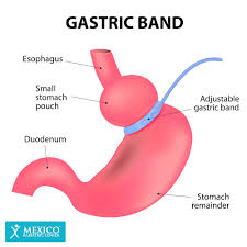 lap band surgery cost mexico starting