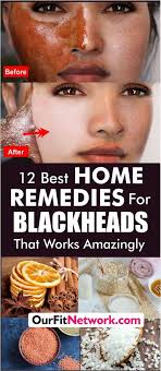 12 best home remes for blackheads
