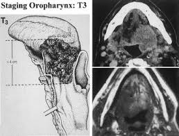 oropharynx cavity floor of the