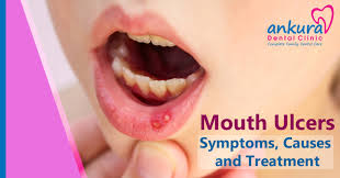 mouth ulcers symptoms causes and