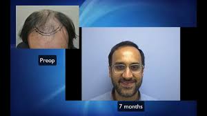 Or are there examples which some guys had a significant transform after 9 months. Early Growth At 7 Months After Hair Transplant By Dr Lindsey Lindsey Medical Hair Transplant