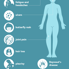 Learn more about the symptoms, complication, causes, types, diagnosis, treatment, lifestyle changes, and outlook for lupus. Lupus Signs Symptoms And Complications