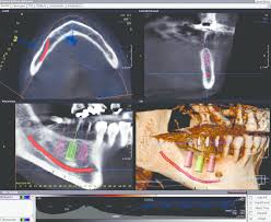 dental cbct is the presurgical planning