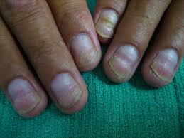 indentation across fingernails mdedge