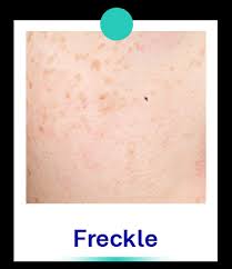 freckles sun and dark spots bangkok