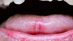 what causes canker sores the new