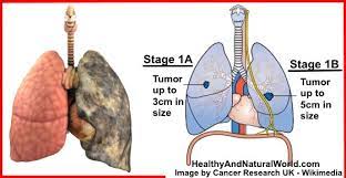 As the cancer develops, these symptoms may become more severe or intense. 7 Warning Signs Of Lung Cancer You Shouldn T Ignore