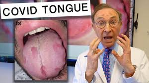 what is covid tongue you