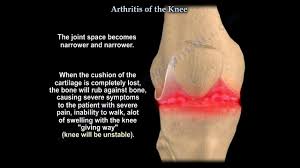 knee arthritis symptoms and treatment