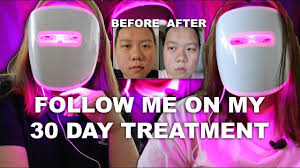 Does It Work Neutrogena Light Therapy Acne Mask