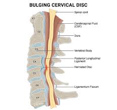 a chiropractor help with a bulging disc