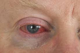 red bloodshot eyes causes and