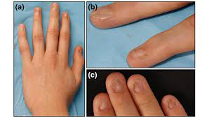 nail patella syndrome report of 11