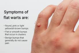 flat warts causes symptoms diagnosis