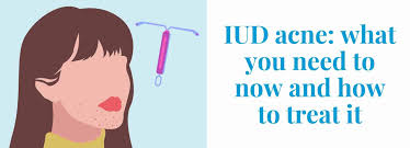 iud acne how iud s can cause acne and