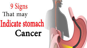 It is also known as gastric cancer. 9 Signs That May Indicate Stomach Cancer Natural Health Youtube