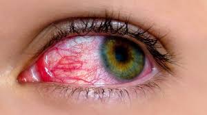 pink eye conjunctivitis symptoms