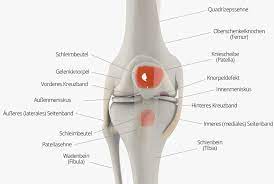 Korrespondierend gilt für das valgustrauma. Schmerzen Im Knie Ursachen Therapie Knorpelexperte De