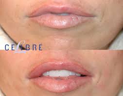 lip filler before and after pictures