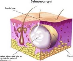 popping a sebaceous cyst can i burst