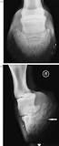 what-is-a-pedal-bone-fracture