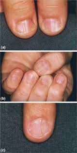 isolated con nail dysplasia