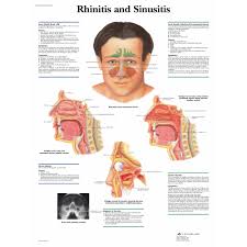 Rhinitis And Sinusitis Chart