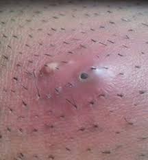ingrown hairs a painful problem