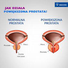 Prostata | Łagodny rozrost gruczołu krokowego