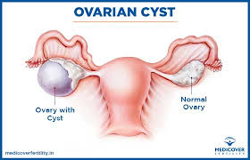Check spelling or type a new query. How To Get Pregnant With Ovarian Cysts Medicover Fertility