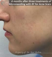 laser treatment acne scars nyc acne