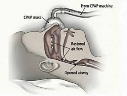 Image result for CPAP