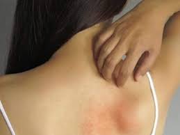 home remes to get rid of heat rashes