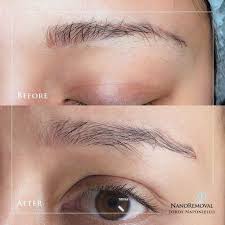 microblading removal when and how to