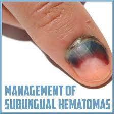 subungual hematoma management sports