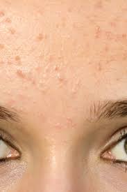 forehead acne and pimples causes