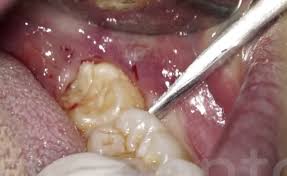 how to remove your wisdom tooth